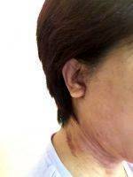 Lower Face And Neck Lift Scars Photos (1)