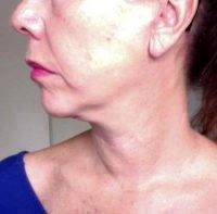 Lower Facelift Eliminates Jowls