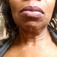 Lower Facelift Surgery Age