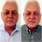 Male Facelift Before After Image