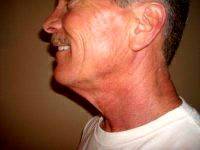 Male Facelifts And Neck Lift