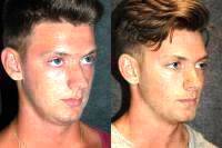 Male Rhinoplasty Before And After
