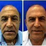 Mens Facelift Before And After Pic
