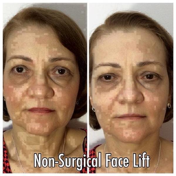 Microcurrent Face Lift Before And After Pictures 7 Facelift Info Prices Photos Reviews Qanda