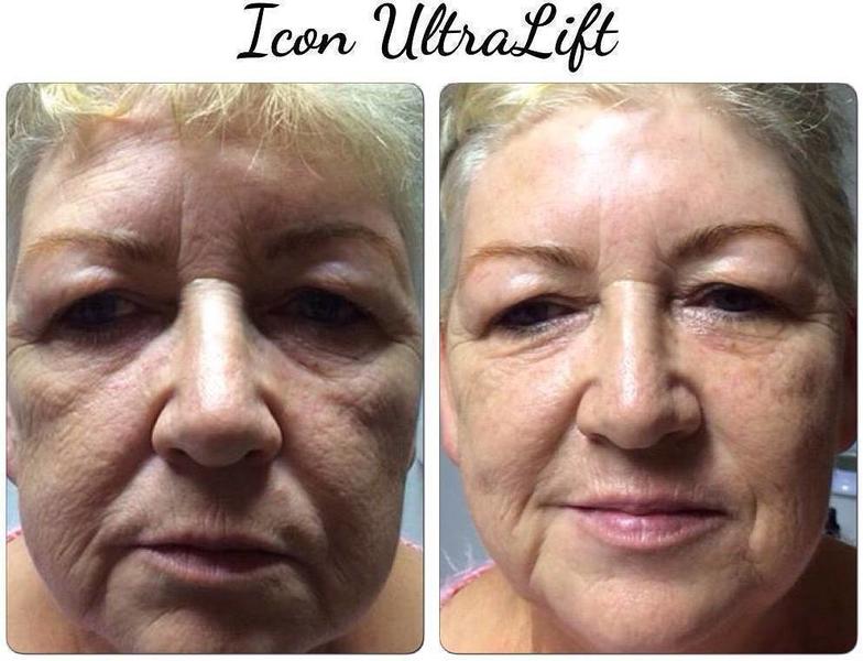Microcurrent Facial Before After 3 Facelift Info Prices Photos Reviews Qanda