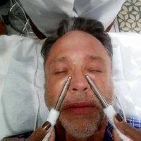 Microcurrent Facial Before After (7)