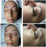 Microcurrent Facial Before And After Photos (5)