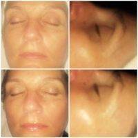 Microcurrent Facial Before And After Photos (6)