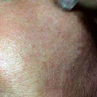 Microcurrent For Skin Tightening