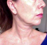 Neck And Jowl Liposuction
