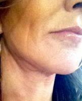 Neck And Lower Face Lift With Dr Oleh Slupchynskyj