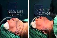 Neck Lift Surgery Before And After Photo