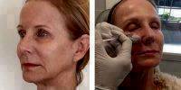 Non Invasive Botox Facial Photos