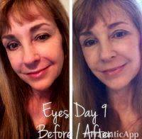 Non Invasive Facelift In Fresno Before And After