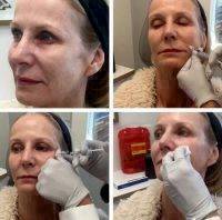 Non Surgical Face Lift With Botox