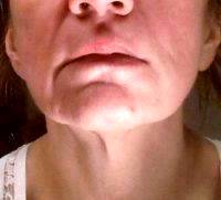 Options For Correcting Loose Jowls