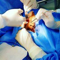 PLASTIC SURGERY UNDER LOCAL AND TWILIGHT ANESTHESIA WITHOUT GENERAL ANESTHESIA