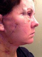 Pictures Of Lower Facelift Recovery (3)
