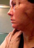 Pictures Of Lower Facelift Recovery (7)