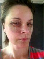 Post Facelift Bruising Pictures (2)