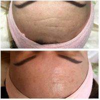 Radio Frequency Facelift Treatment Before And After (10)