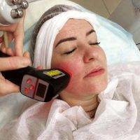 Radio Frequency Facelift Treatment Before And After (15)