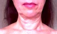 Reduce Jowls Without Surgery