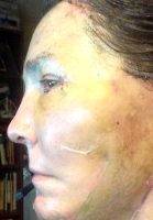 Reduced Recovery Time Compared To A Full Facelift