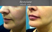 Restylane Before And After