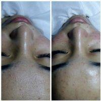 Rf Facelift Before And After (3)