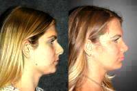 Rhinoplasty Before And After