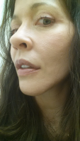 Rhytidectomy Can Improve Many Areas Of The Face