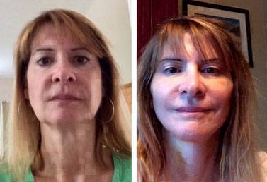 SMAS Facelift Before And After Photos » Facelift: Info, Prices, Photos ...