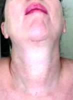 Scar After Lower Face And Neck Lift Photo