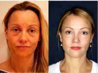 Stem Cell Facelift In Mexico Before And After