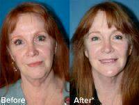 Stop Smoking In Order To Have A Facelift
