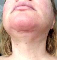 Surgical Facelift Scar By Dr. Alex Campbell