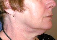 The Deep Plane Lift Is Ideal For People With Severe Facial Sagging