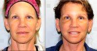 The Lifestyle Lift Is An Alternative To A Traditional Facelift