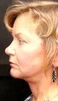 The Short-scar Facelift Candidate
