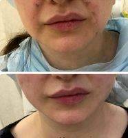 thread lift before after facelift cons pros reviews
