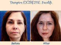 Vampire Extreme Facelift Before And After