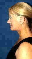 What To Expect From Facelift Surgery In Baltimore