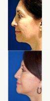 45-54 Year Old Woman Treated With Upper Facelift By Dr. Thomas S. Taylor, MD, FACS, Pasadena Plastic Surgeon