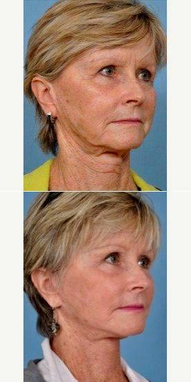 55-64 Year Old Woman Treated With Facelift By Dr Louis P. Bucky, MD, Philadelphia Plastic ...