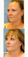 55-64 Year Old Woman Treated With Facelift With Doctor Andrew Turk, MD, Naples Plastic Surgeon
