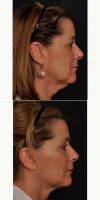 55-64 Year Old Woman Treated With Facelift With Doctor Mark Glasgold, MD, Highland Park Facial Plastic Surgeon