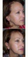 Doctor Hayley Brown, MD, FACS, Las Vegas Plastic Surgeon 55-64 Year Old Woman Treated With Facelift