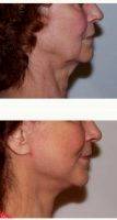 Dr. Robert N. Severinac, MD, Fort Wayne Plastic Surgeon Face And Neck Lift With Deep Tissue Suspension