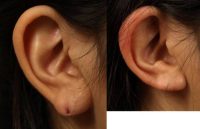 17 or under year old woman treated with Earlobe Surgery